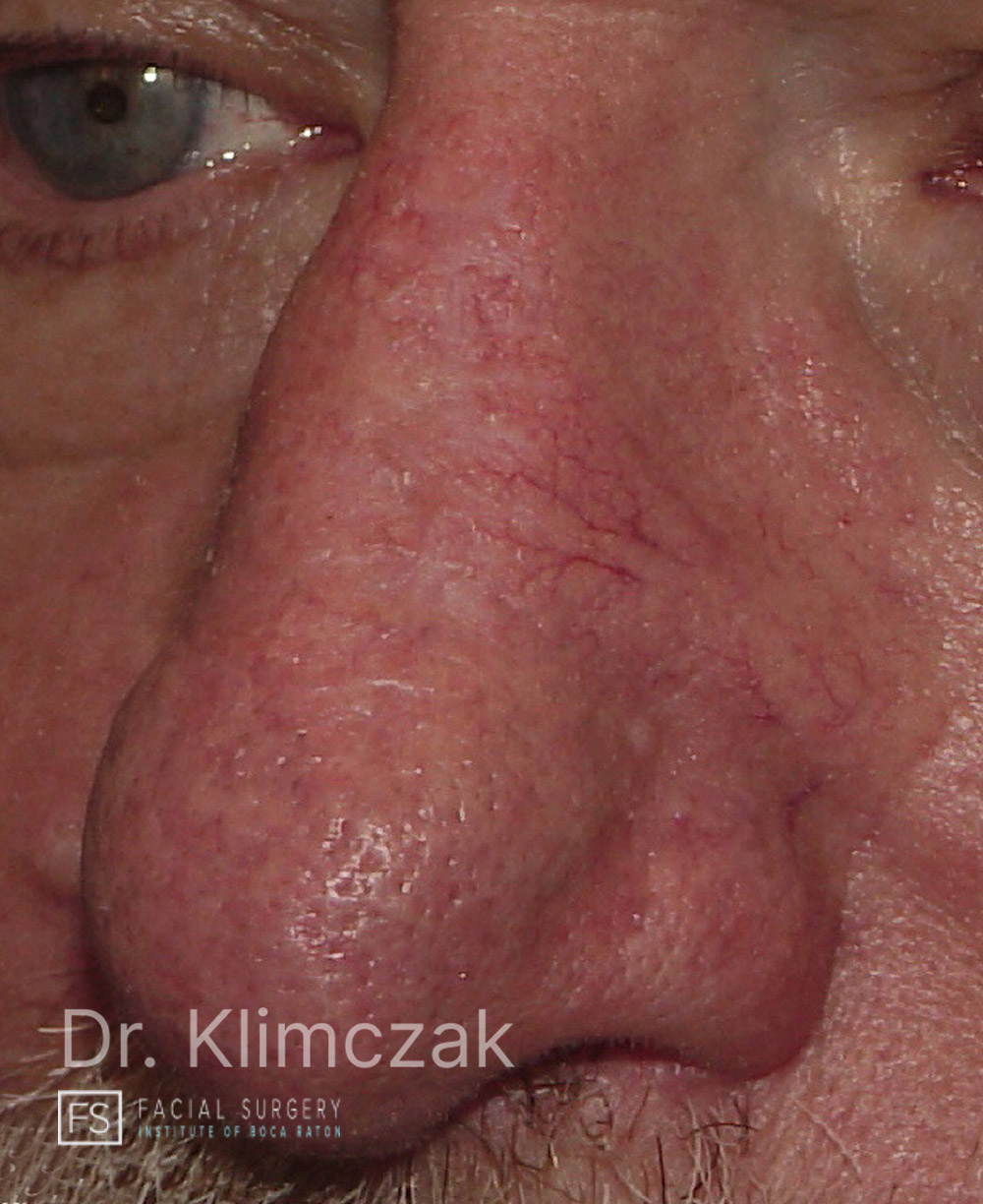 Photo of the patient’s after the Skin Cancer Reconstruction Patient 11