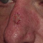 Thumbnail photo of the patient’s before the Skin Cancer Reconstruction Patient 11