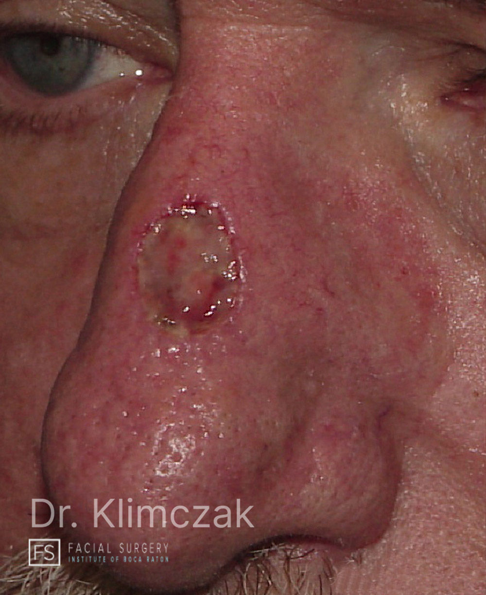 Photo of the patient’s before the Skin Cancer Reconstruction Patient 11