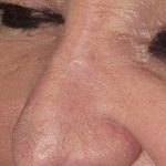 Thumbnail photo of the patient’s after the Skin Cancer Reconstruction Patient 12