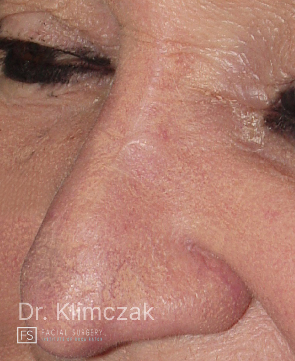 Photo of the patient’s after the Skin Cancer Reconstruction Patient 12