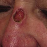 Thumbnail photo of the patient’s before the Skin Cancer Reconstruction Patient 12