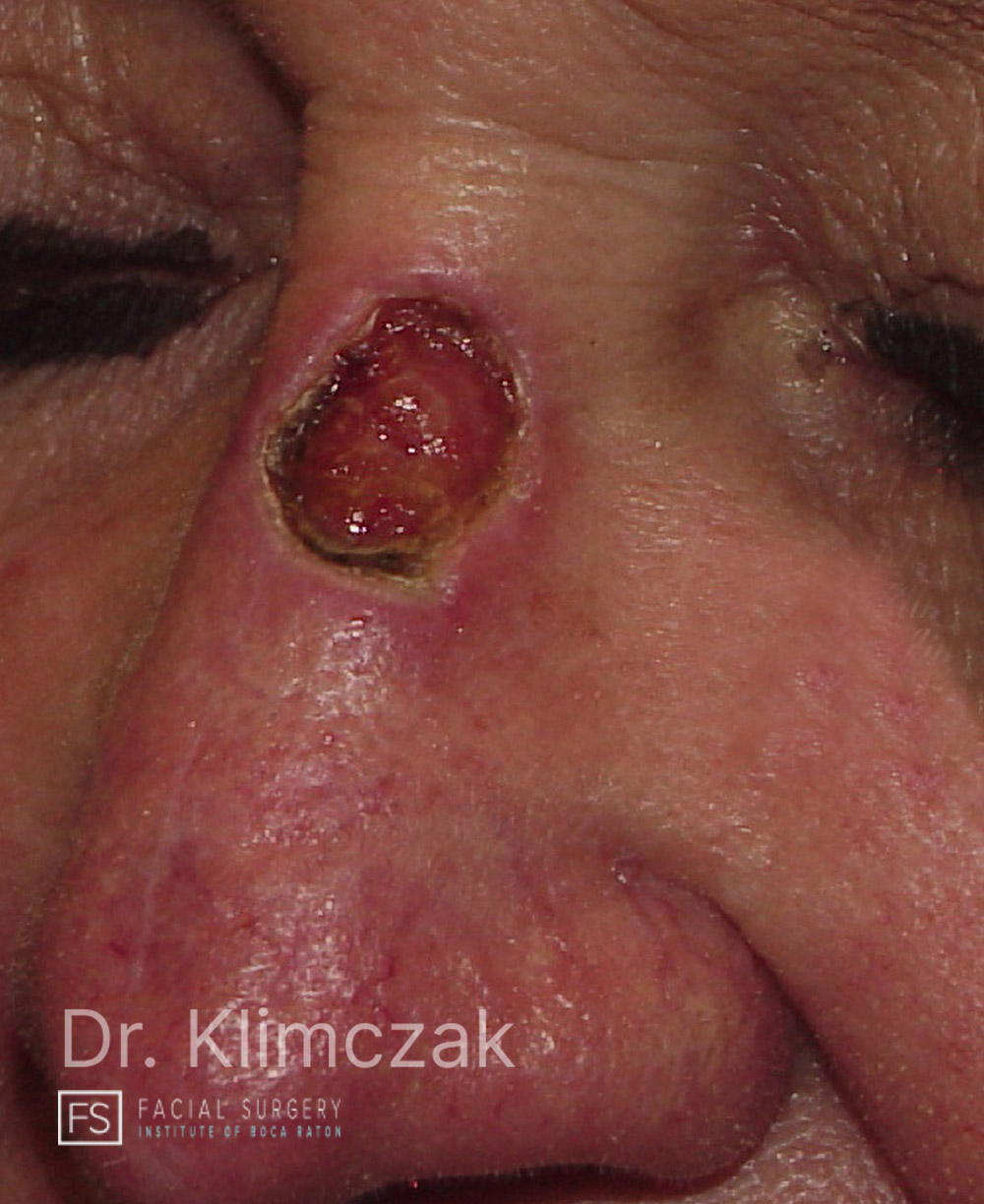 Photo of the patient’s before the Skin Cancer Reconstruction Patient 12