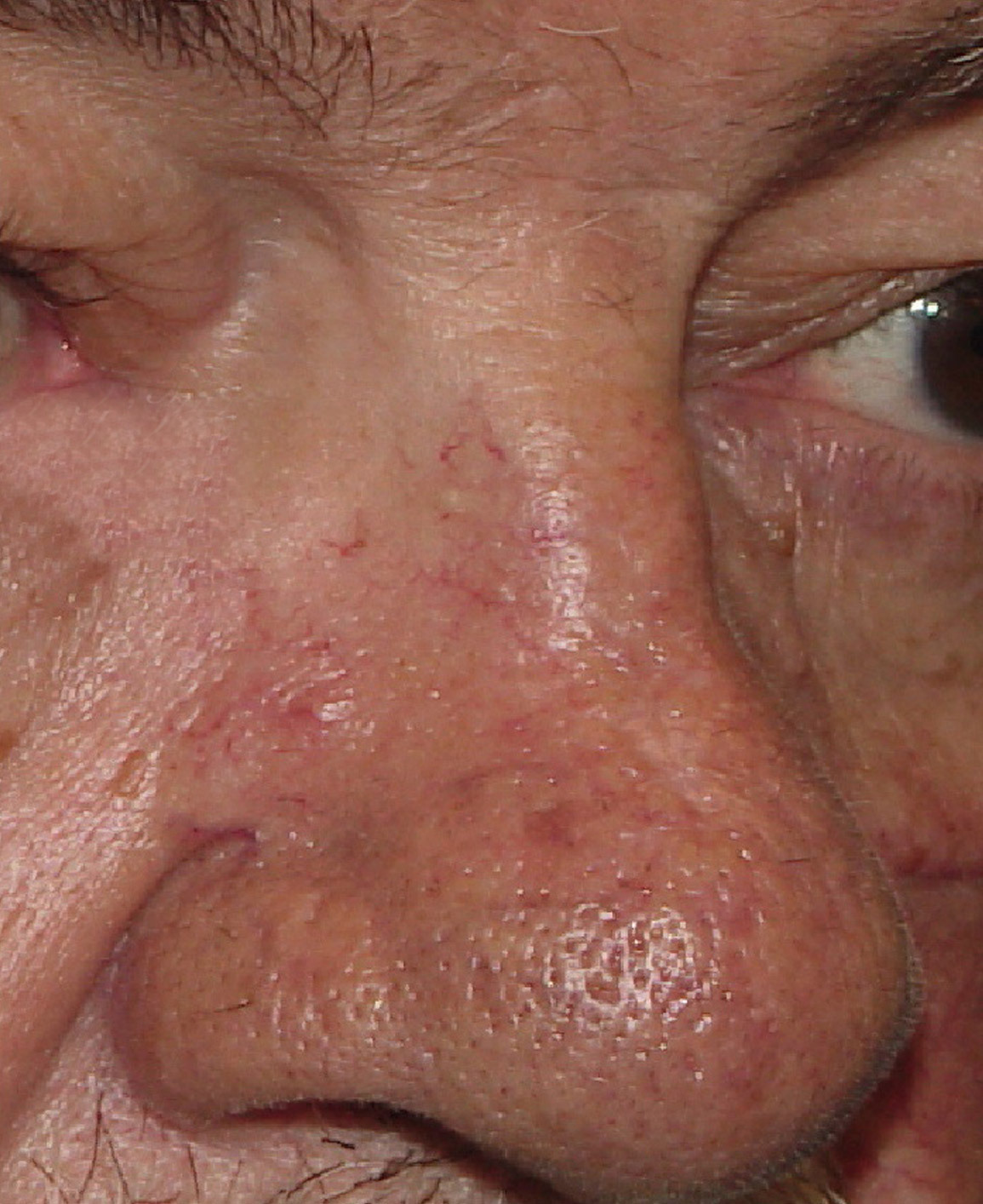 Photo of the patient’s after the Skin Cancer Reconstruction Patient 13