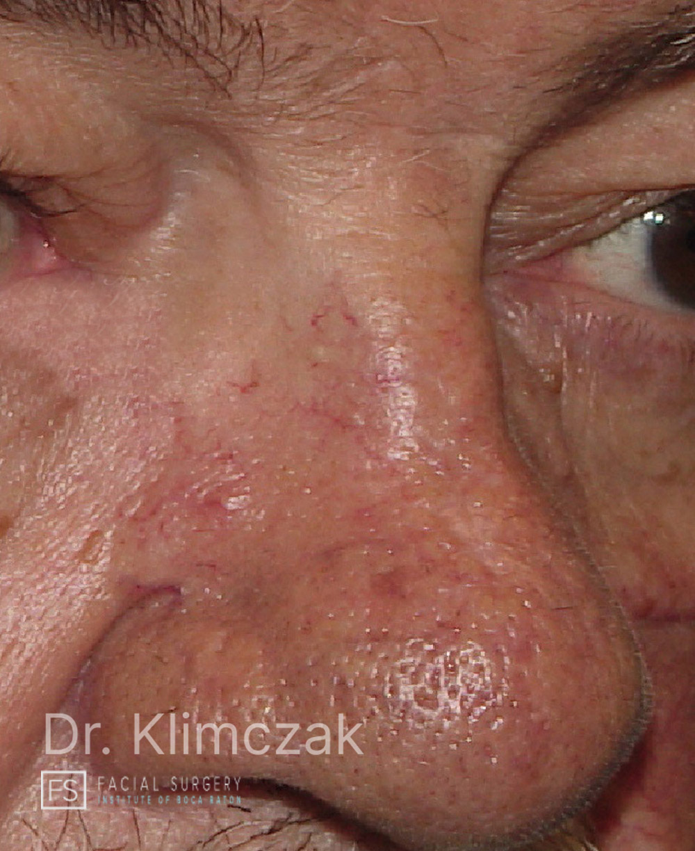 Photo of the patient’s after the Skin Cancer Reconstruction Patient 13