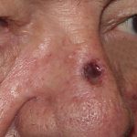 Thumbnail photo of the patient’s before the Skin Cancer Reconstruction Patient 13