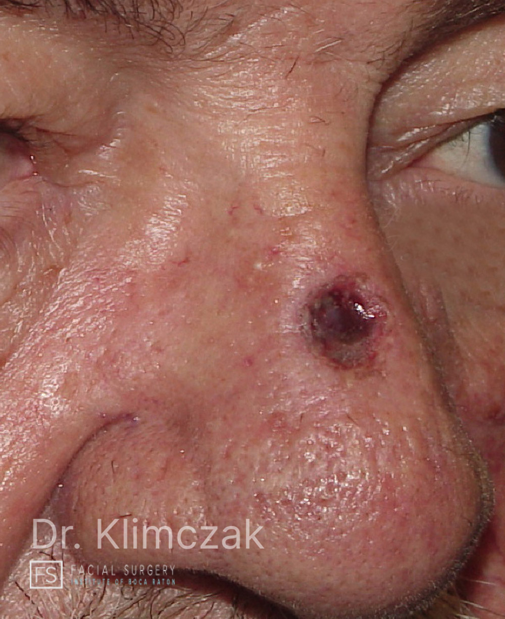 Photo of the patient’s before the Skin Cancer Reconstruction Patient 13