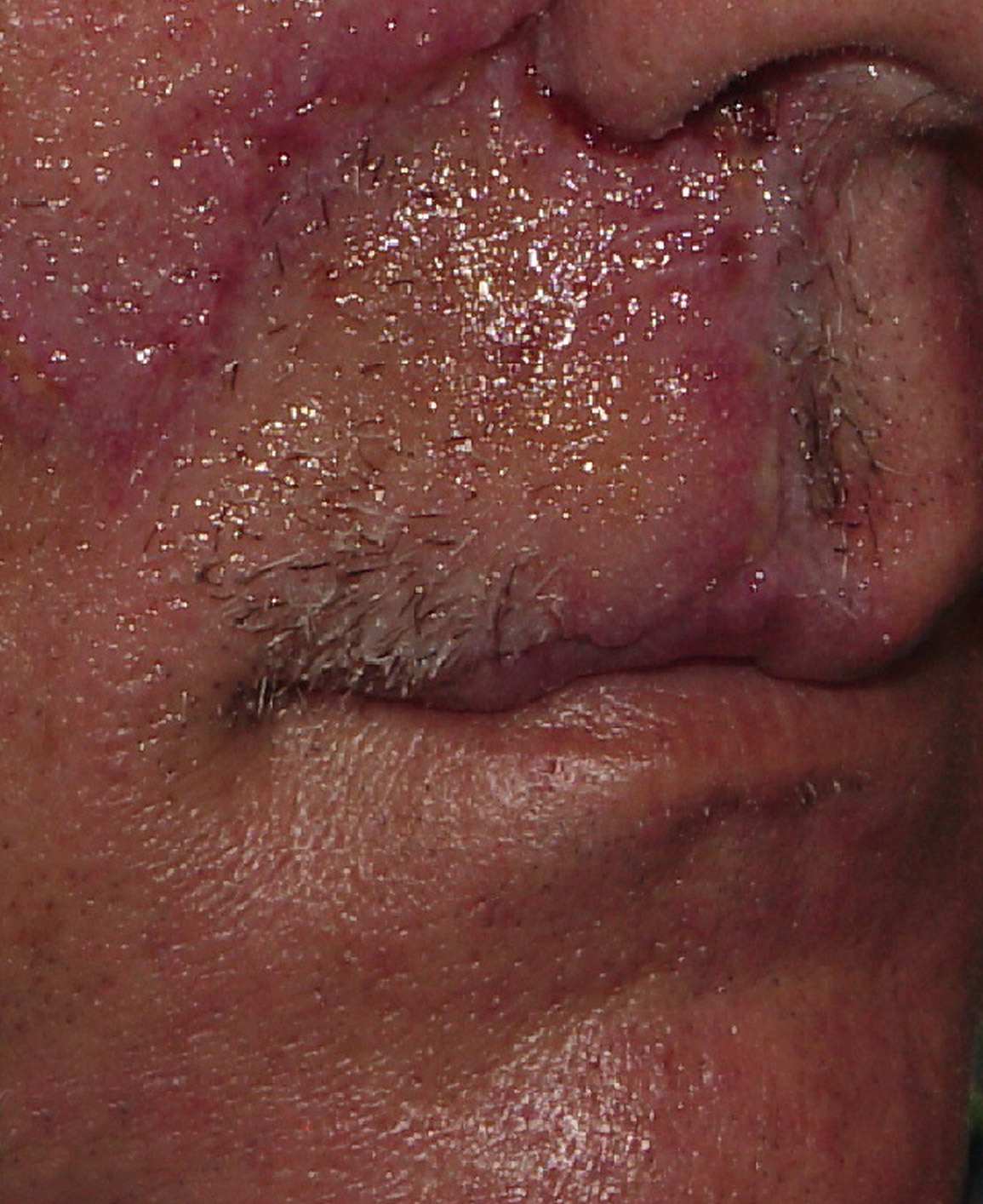 Photo of the patient’s after the Skin Cancer Reconstruction Patient 14