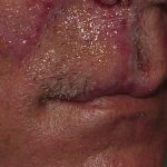 Thumbnail photo of the patient’s after the Skin Cancer Reconstruction Patient 14