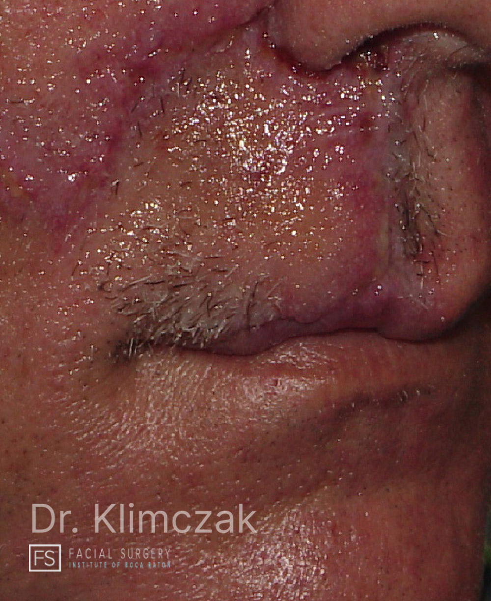 Photo of the patient’s after the Skin Cancer Reconstruction Patient 14