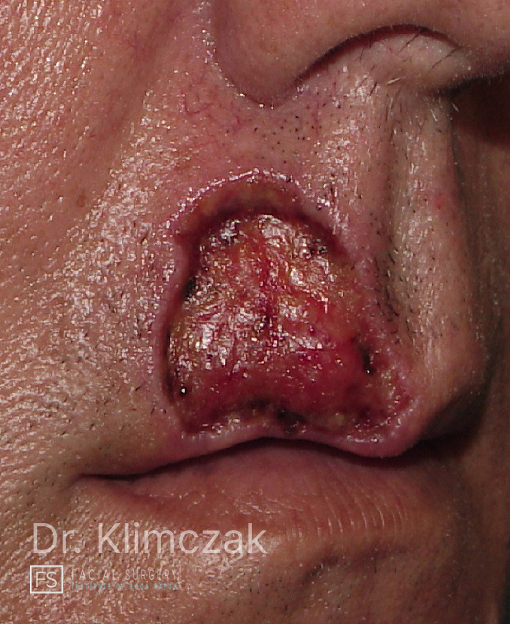 Photo of the patient’s before the Skin Cancer Reconstruction Patient 14