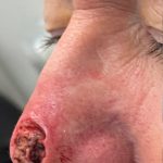 Thumbnail photo of the patient’s before the Skin Cancer Reconstruction Patient 2