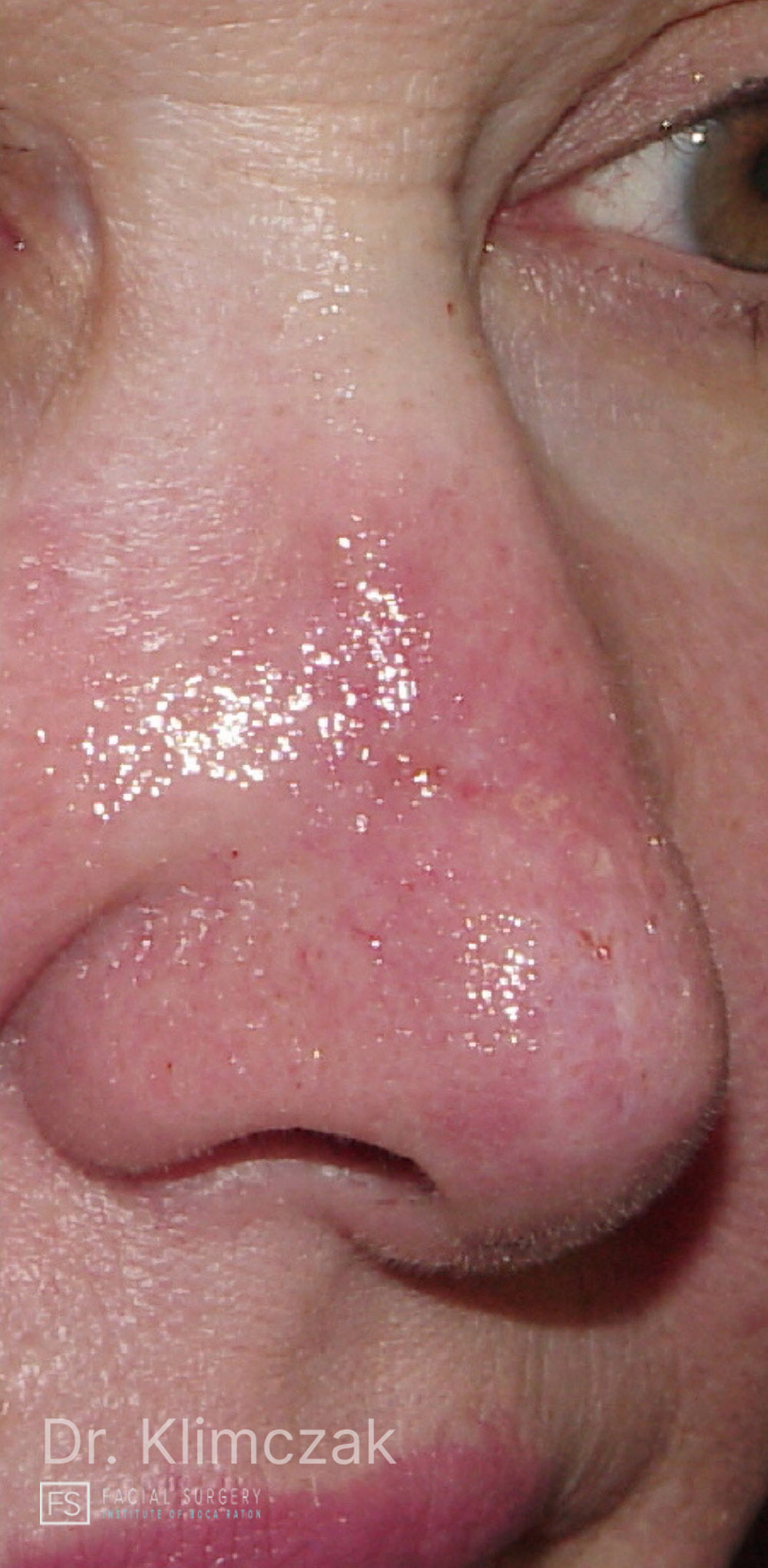 Photo of the patient’s after the Skin Cancer Reconstruction Patient 3