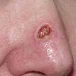 Thumbnail photo of the patient’s before the Skin Cancer Reconstruction Patient 3