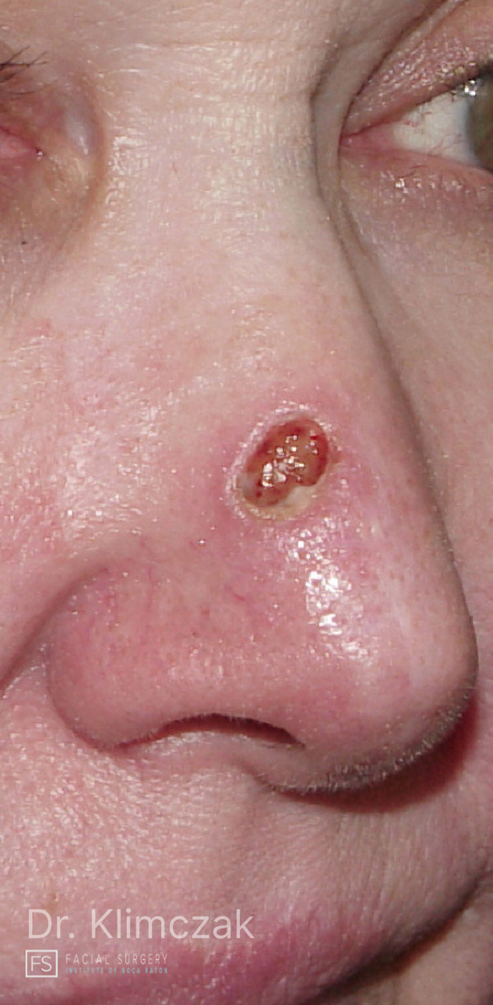 Photo of the patient’s before the Skin Cancer Reconstruction Patient 3