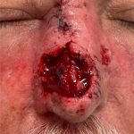 Thumbnail photo of the patient’s before the Skin Cancer Reconstruction Patient 4