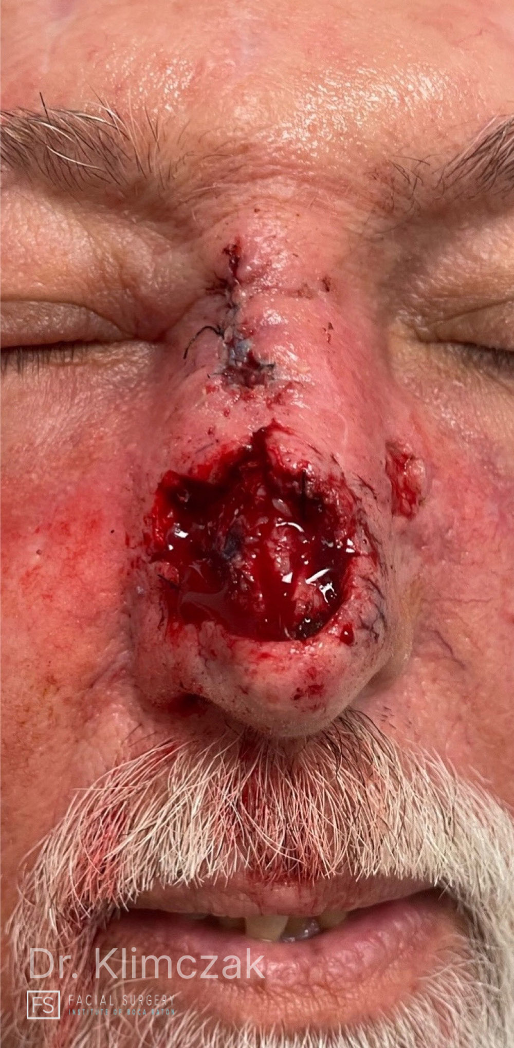 Photo of the patient’s before the Skin Cancer Reconstruction Patient 4