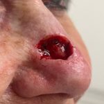 Thumbnail photo of the patient’s before the Skin Cancer Reconstruction Patient 5