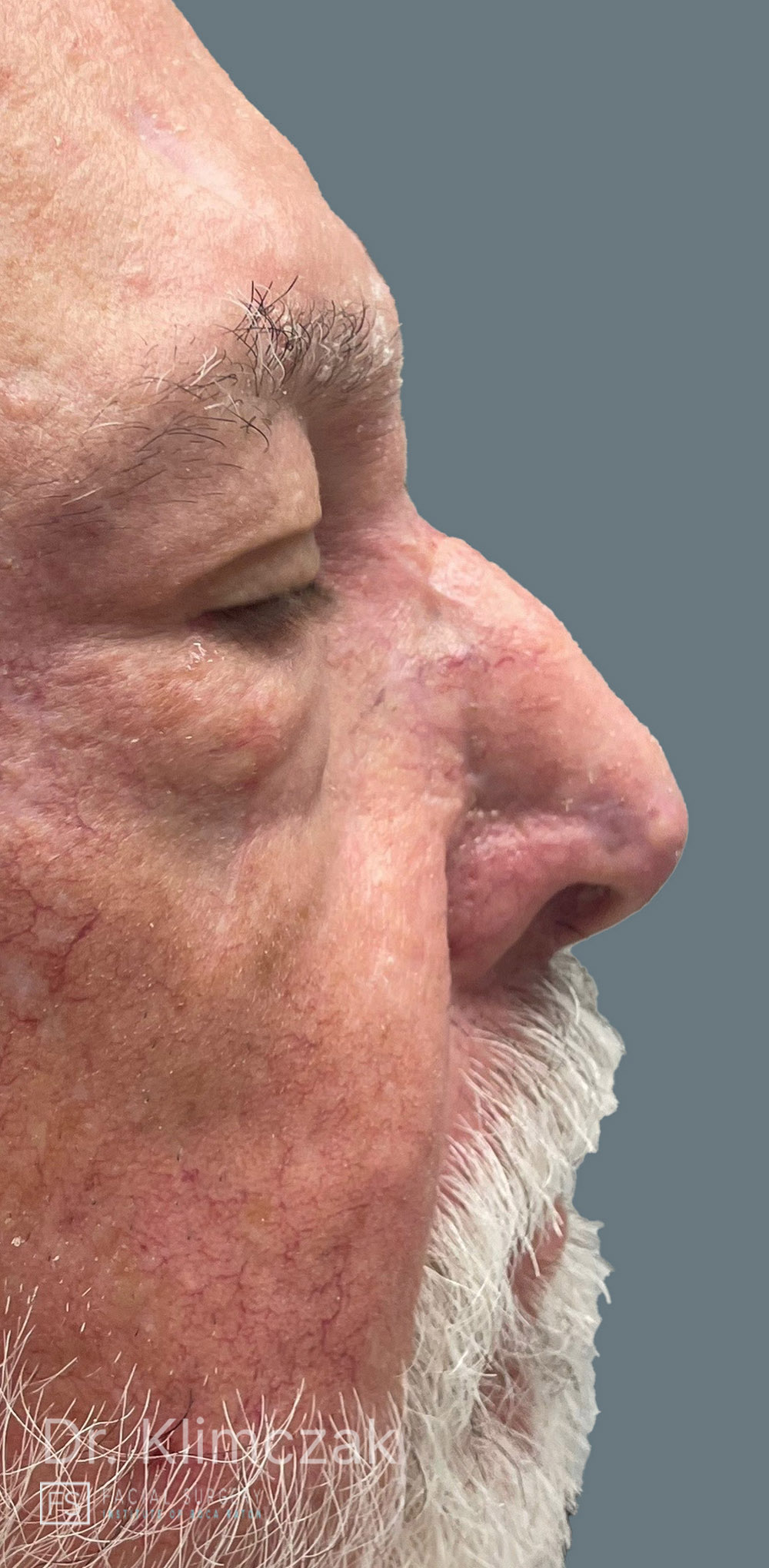 Photo of the patient’s after the Skin Cancer Reconstruction Patient 6