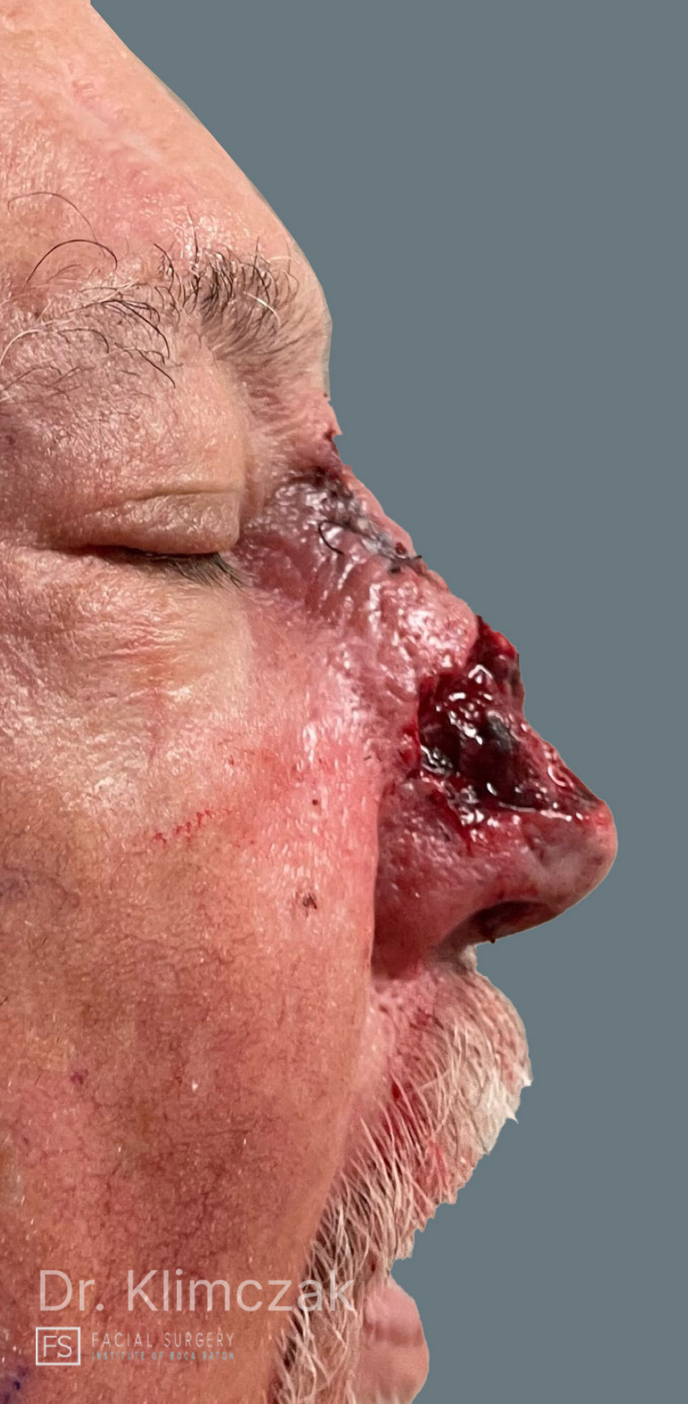 Photo of the patient’s before the Skin Cancer Reconstruction Patient 6