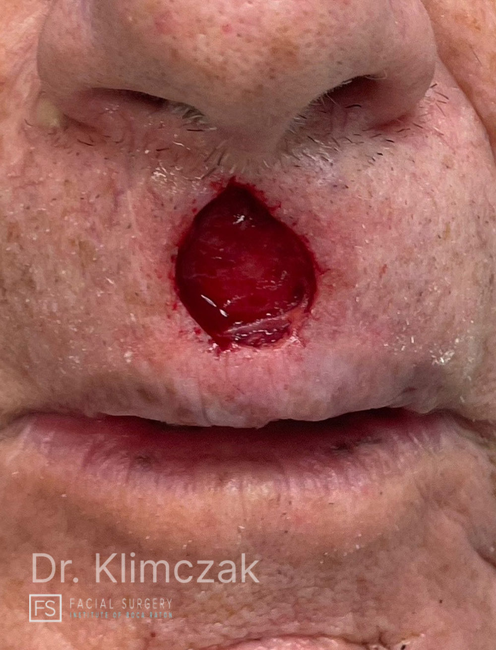 Photo of the patient’s before the Skin Cancer Reconstruction Patient 7