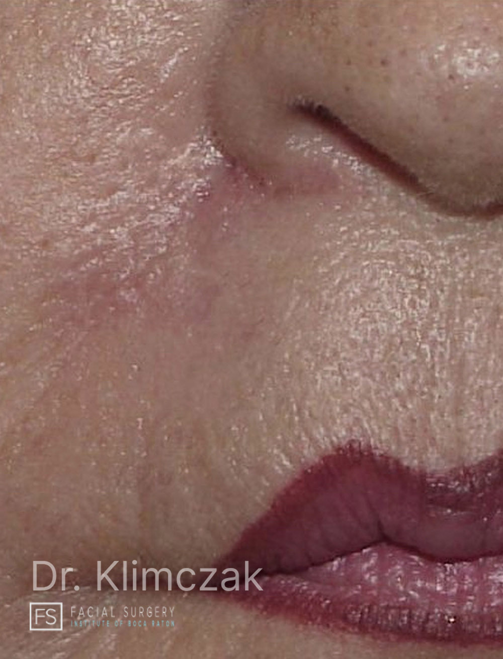 Photo of the patient’s after the Skin Cancer Reconstruction Patient 8