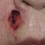 Thumbnail photo of the patient’s before the Skin Cancer Reconstruction Patient 8