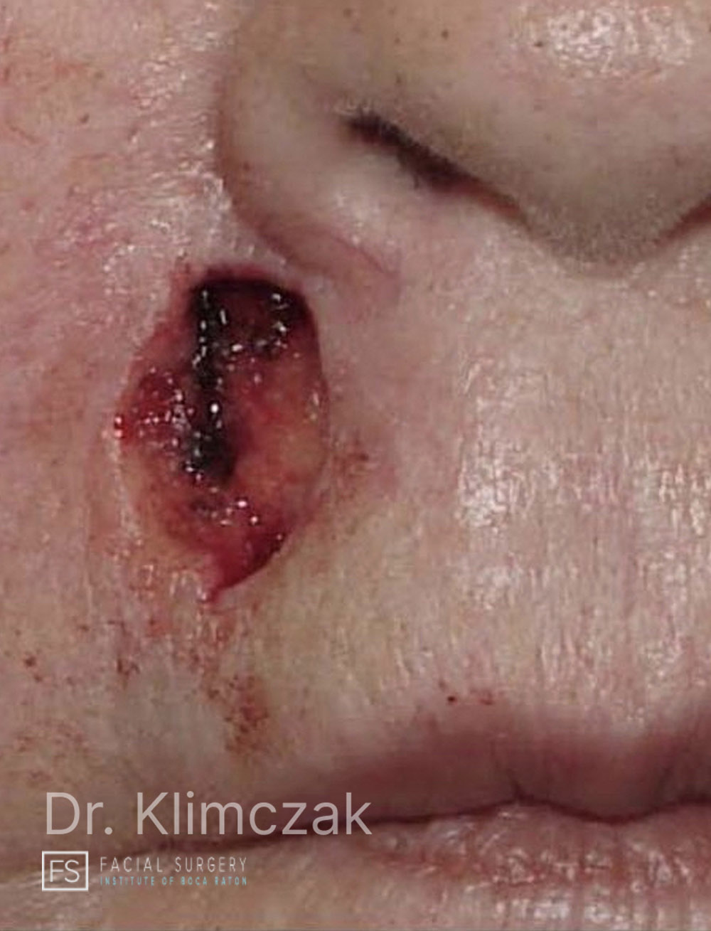 Photo of the patient’s before the Skin Cancer Reconstruction Patient 8