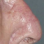 Thumbnail photo of the patient’s after the Skin Cancer Reconstruction Patient 9