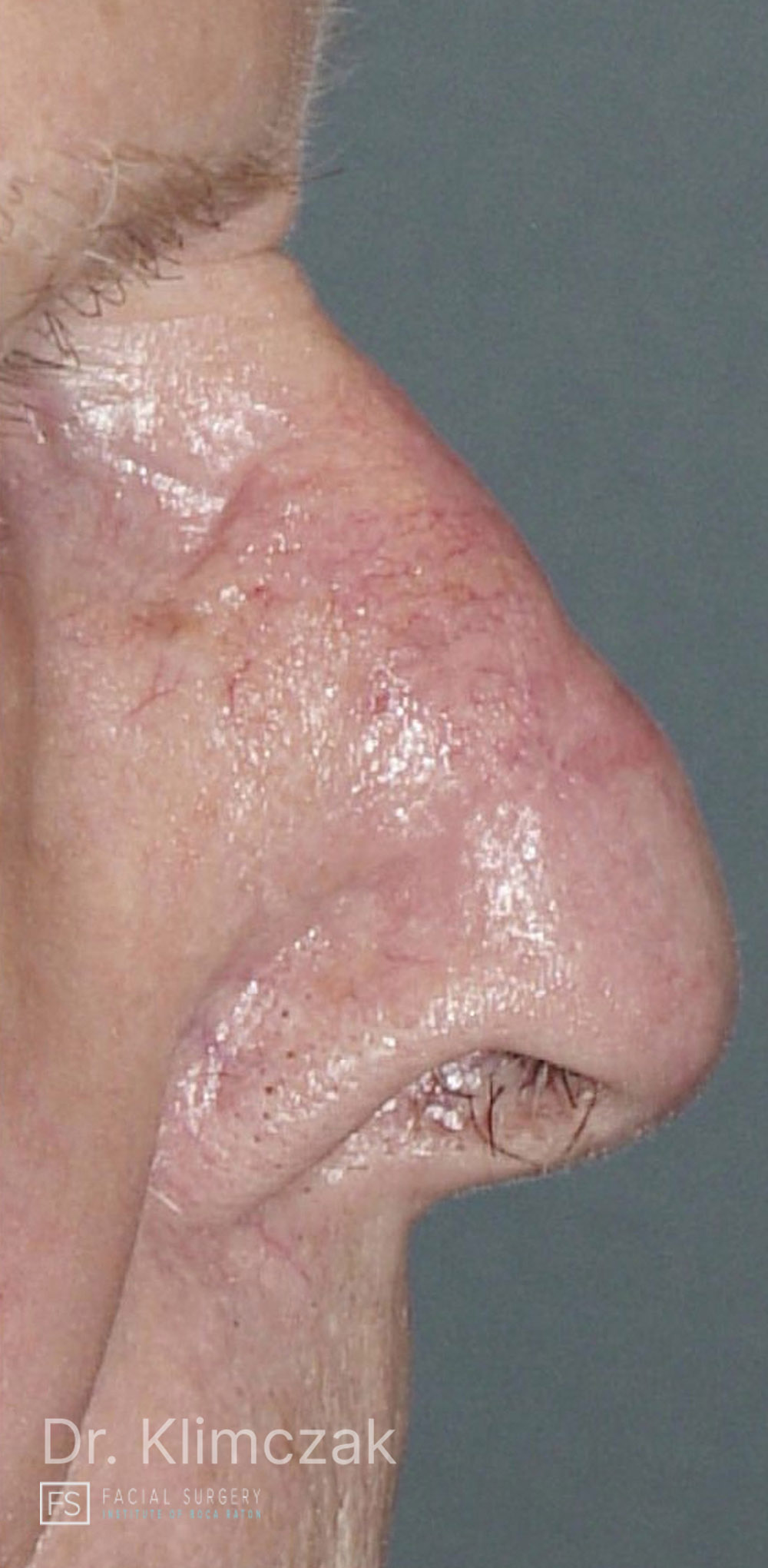 Photo of the patient’s after the Skin Cancer Reconstruction Patient 9