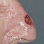 Thumbnail photo of the patient’s before the Skin Cancer Reconstruction Patient 9