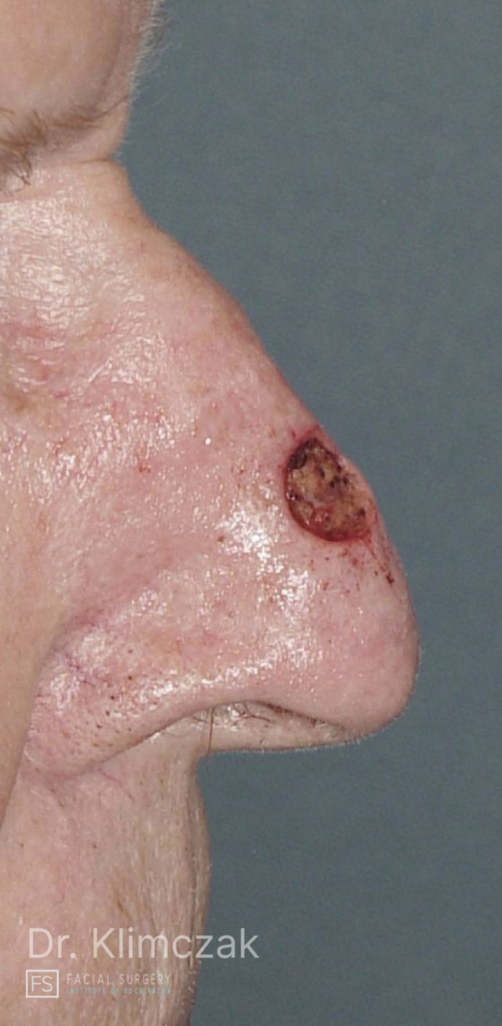 Photo of the patient’s before the Skin Cancer Reconstruction Patient 9