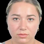 Thumbnail photo of the patient’s after the Rhinoplasty Patient 15