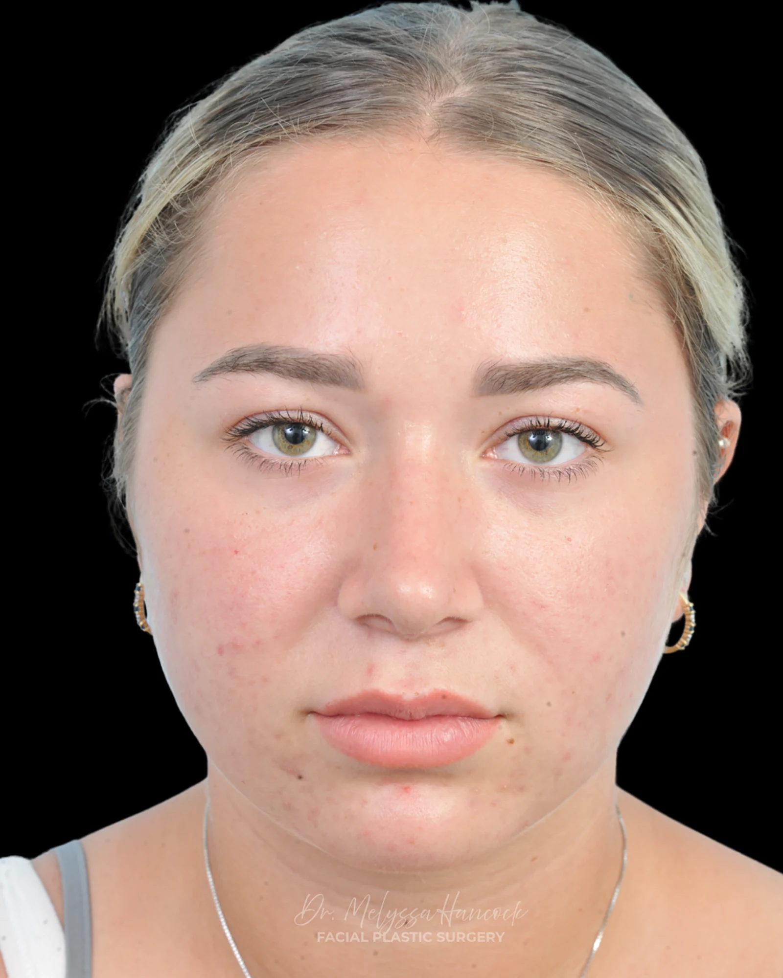 Photo of the patient’s after the Rhinoplasty Patient 15