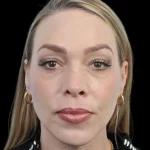 Thumbnail photo of the patient’s after the Rhinoplasty Patient 20