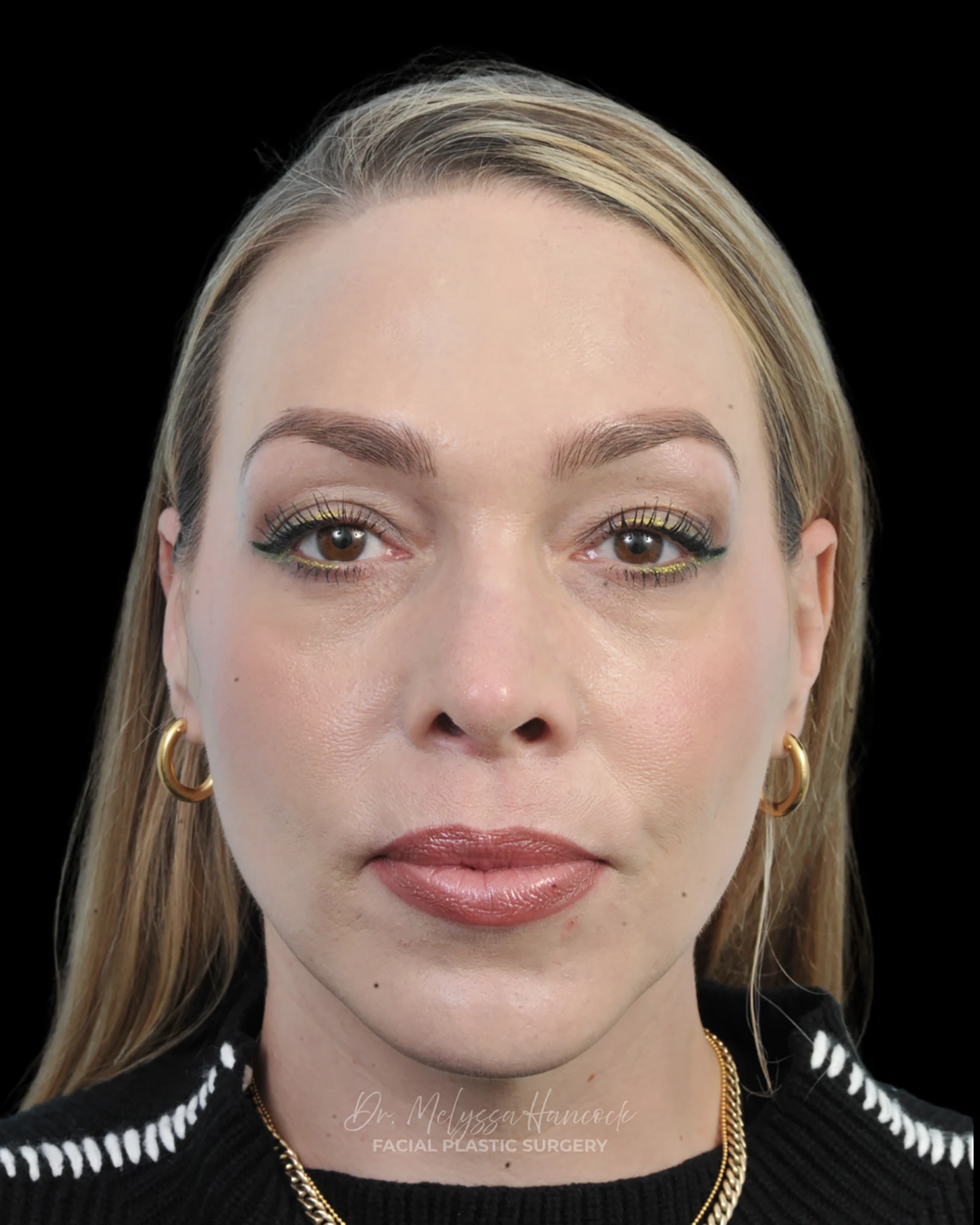Photo of the patient’s after the Rhinoplasty Patient 20