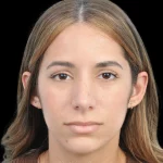 Thumbnail photo of the patient’s after the Rhinoplasty Patient 26