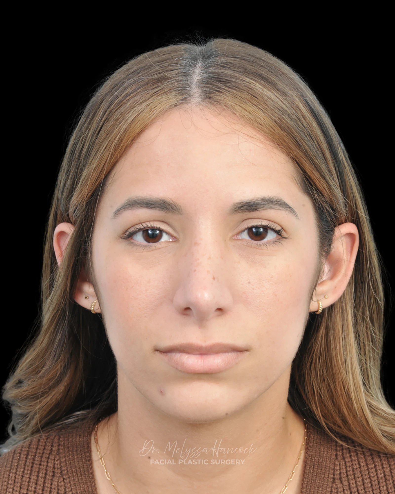 Photo of the patient’s after the Rhinoplasty Patient 26