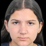 Thumbnail photo of the patient’s after the Rhinoplasty Patient 28