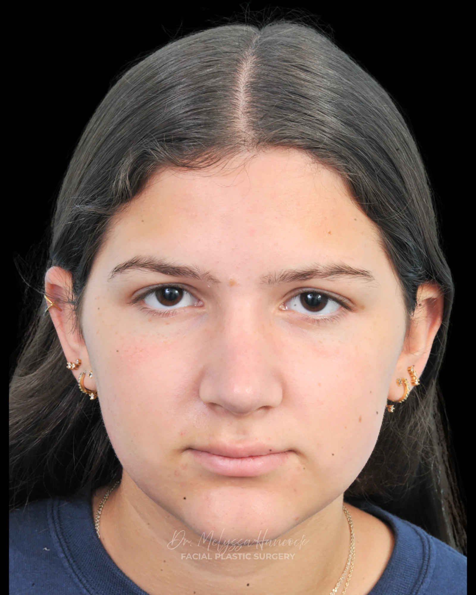 Photo of the patient’s after the Rhinoplasty Patient 28