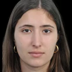 Thumbnail photo of the patient’s after the Rhinoplasty Patient 29