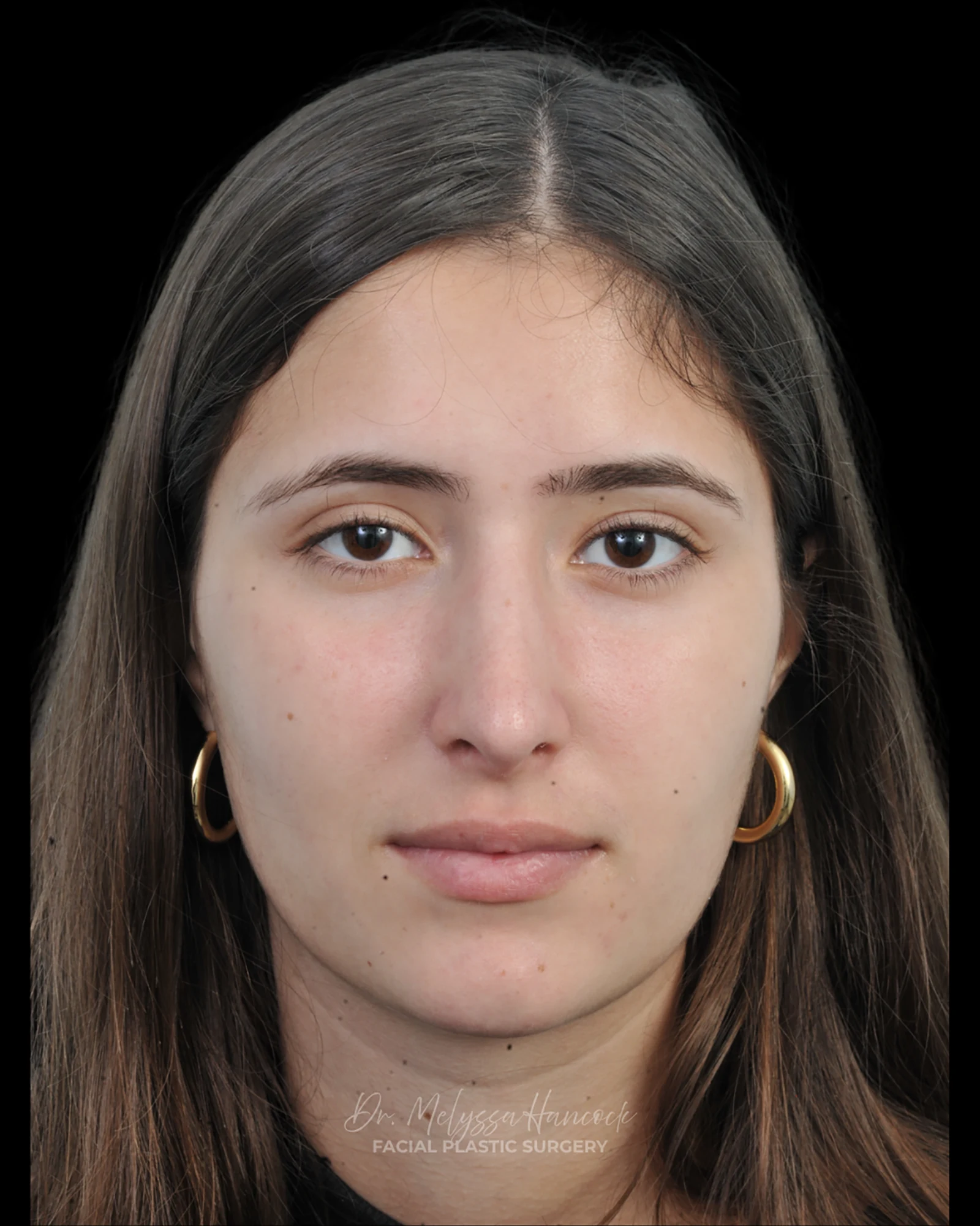 Photo of the patient’s after the Rhinoplasty Patient 29