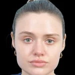 Thumbnail photo of the patient’s after the Rhinoplasty Patient 30