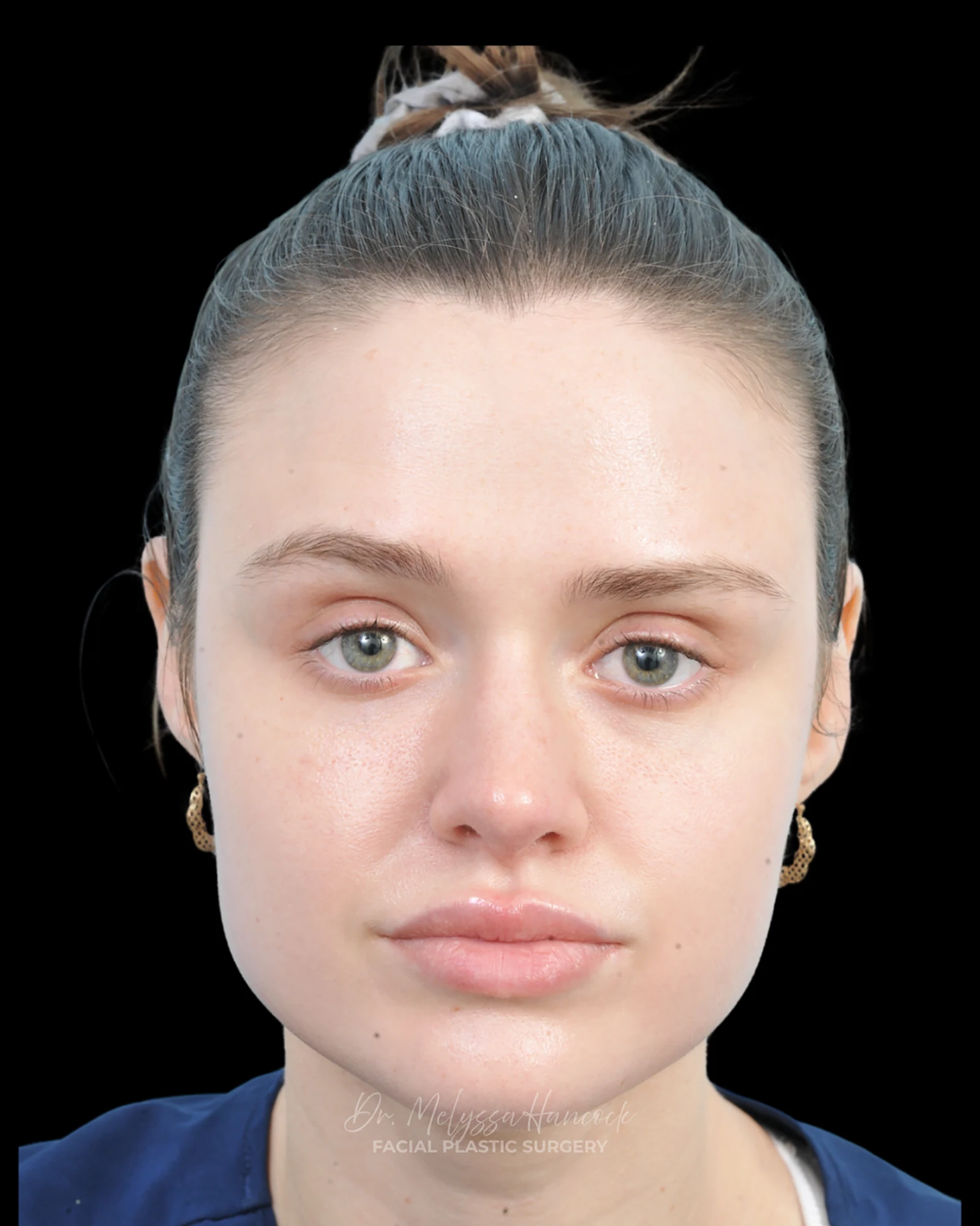 Photo of the patient’s after the Rhinoplasty Patient 30