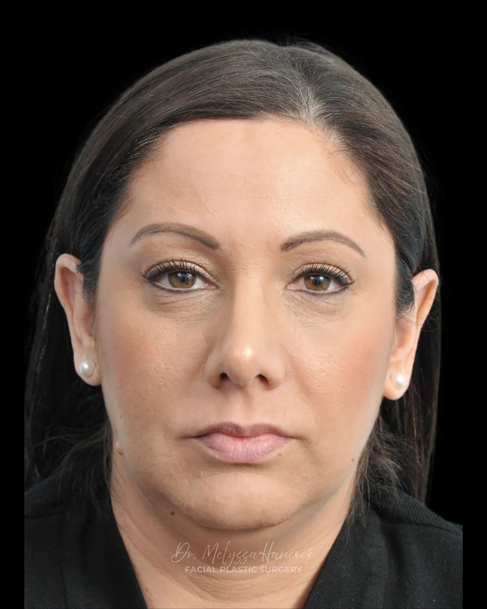 Photo of the patient’s after the Rhinoplasty Patient 32