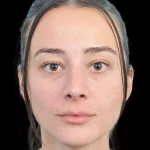 Thumbnail photo of the patient’s after the Rhinoplasty Patient 33