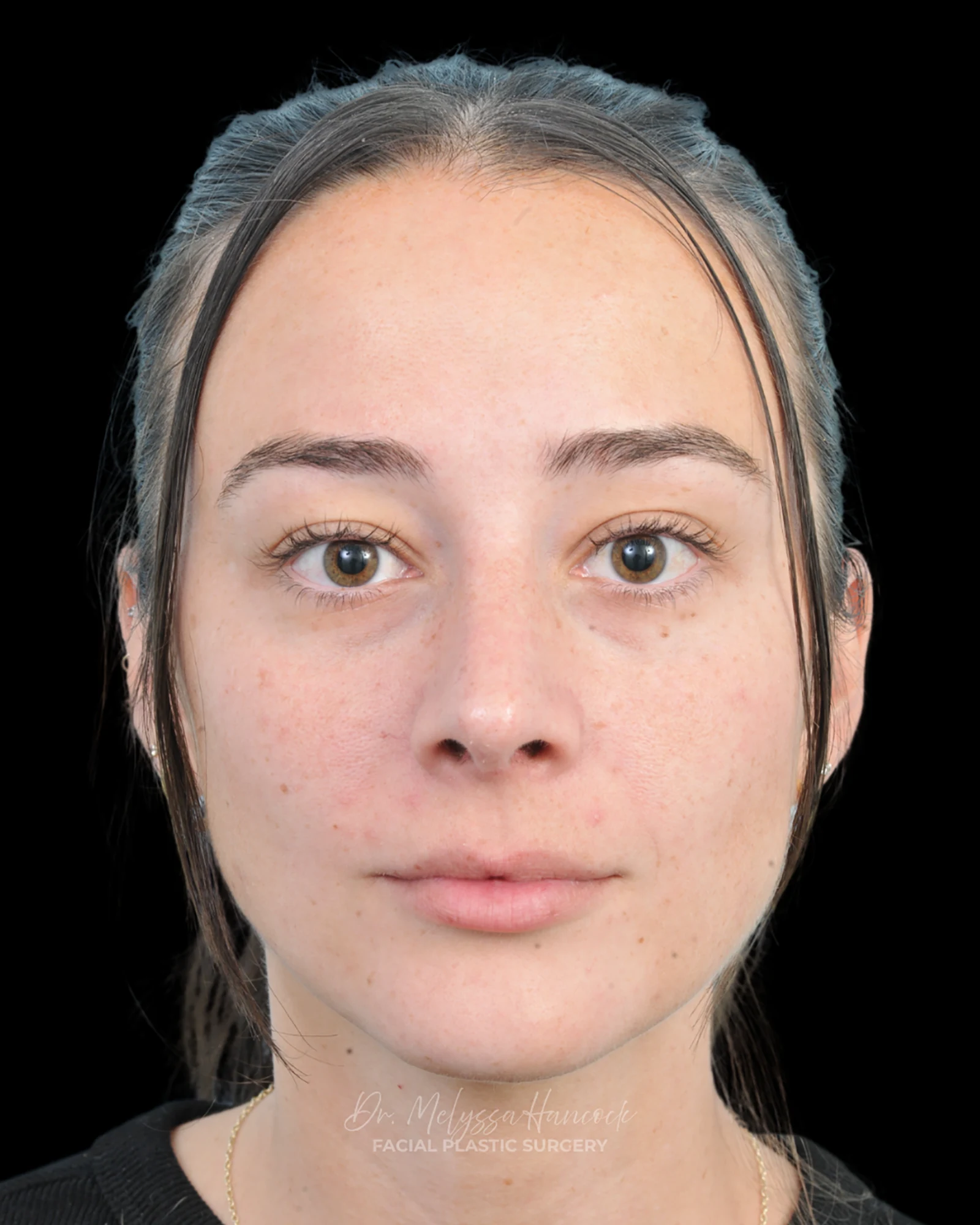 Photo of the patient’s after the Rhinoplasty Patient 33