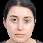 Thumbnail photo of the patient’s after the Rhinoplasty Patient 34