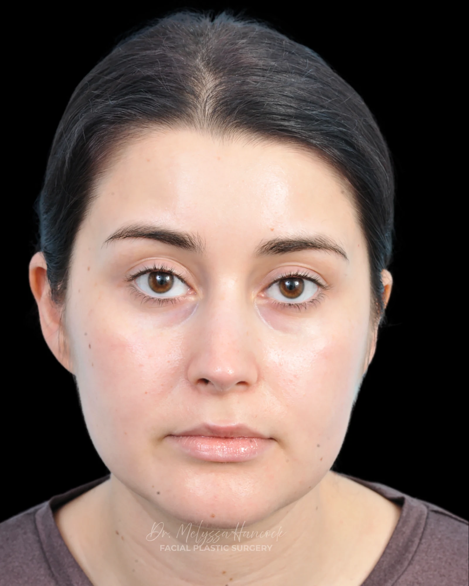 Photo of the patient’s after the Rhinoplasty Patient 34