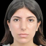 Thumbnail photo of the patient’s after the Rhinoplasty Patient 35